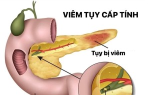Viêm tụy cấp do tăng mỡ máu